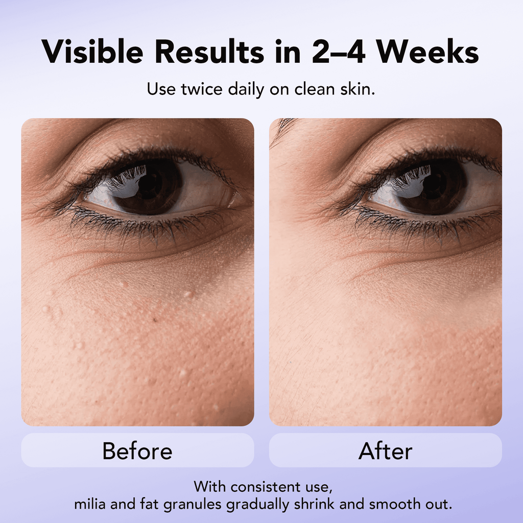 30 mL Treatment, Milia Spot Treatment with Salicylic Acid Milia Acne Serum Clearing Skin Essence